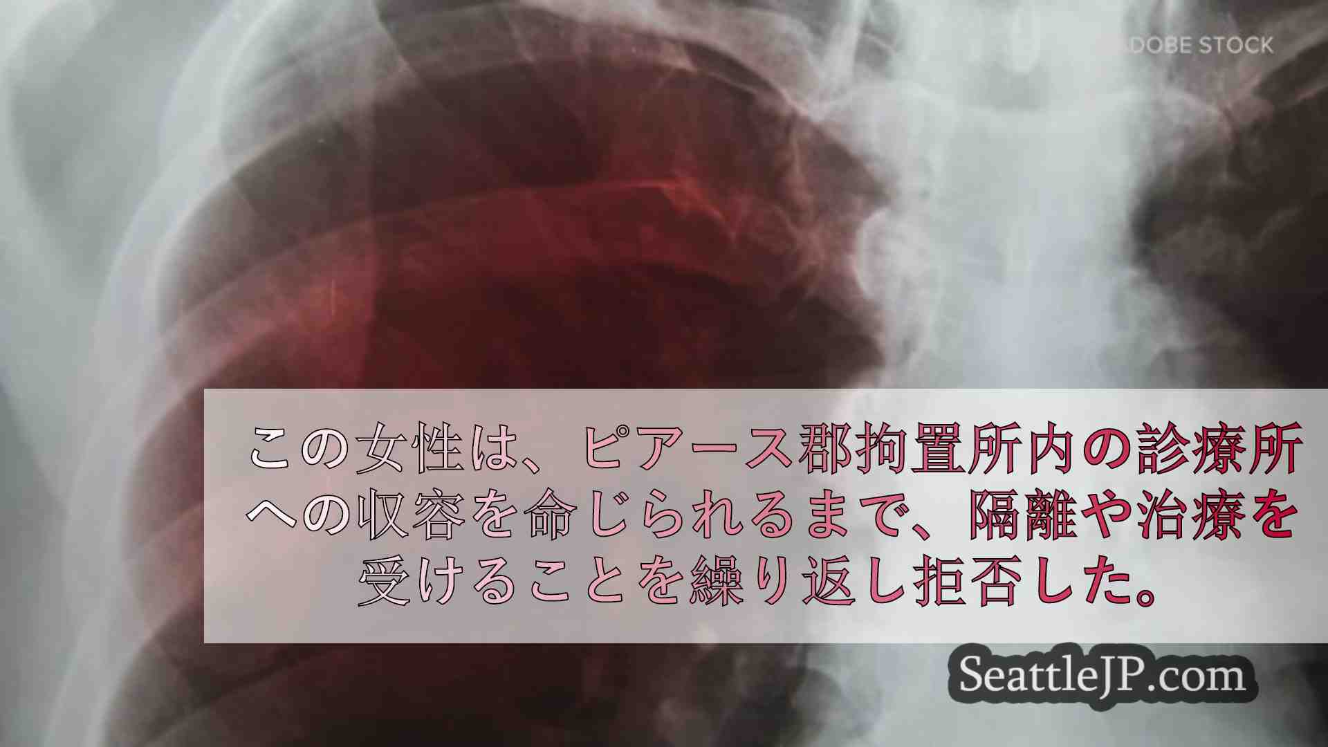 結核の治療を拒否したピアス郡の女性が完治