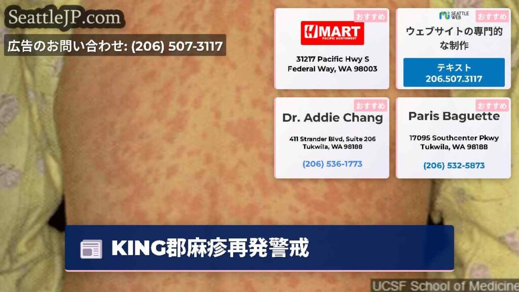 KING郡麻疹再発警戒