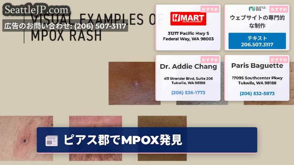 シアトルニュース 1 ピアス郡でMPOX発見